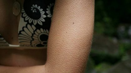 goosebump