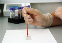 Седми пациент излекуван от ХИВ