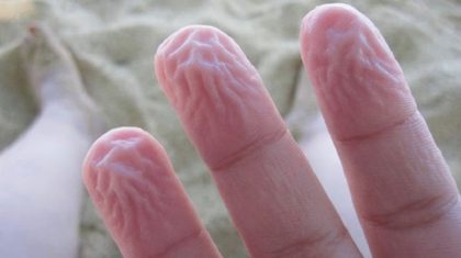 wrinkling_of_the_skin